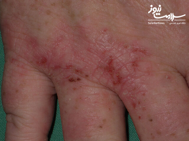 عوارض پوستی