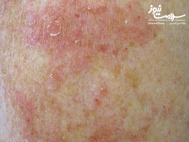 عوارض پوستی