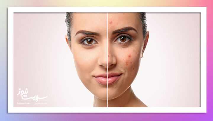 تاثیر خودارضایی بر چهره تاثیر خودارضایی بر چهره