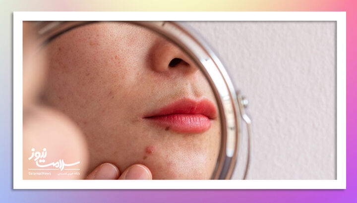 خودارضایی باعث آکنه صورت و بدن می شود؟ خودارضایی باعث آکنه صورت و بدن می شود؟