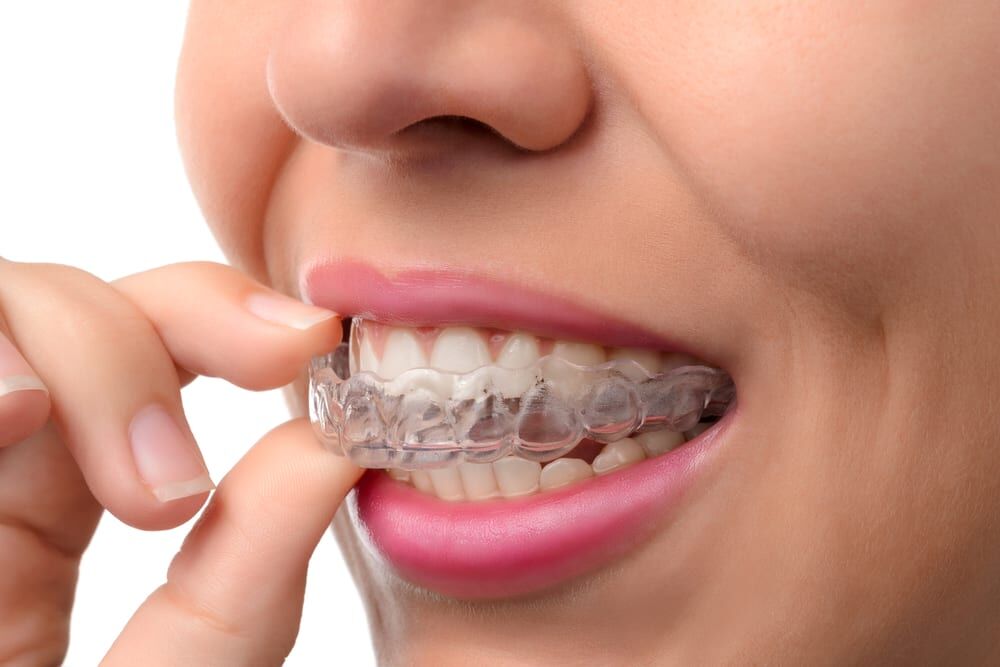 جدیدترین روش های ارتودنسی دندان