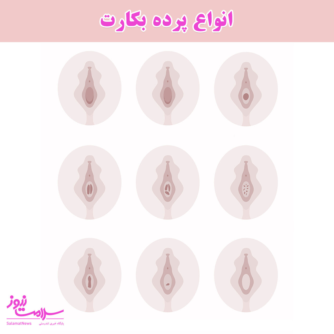 انواع پرده بکارت