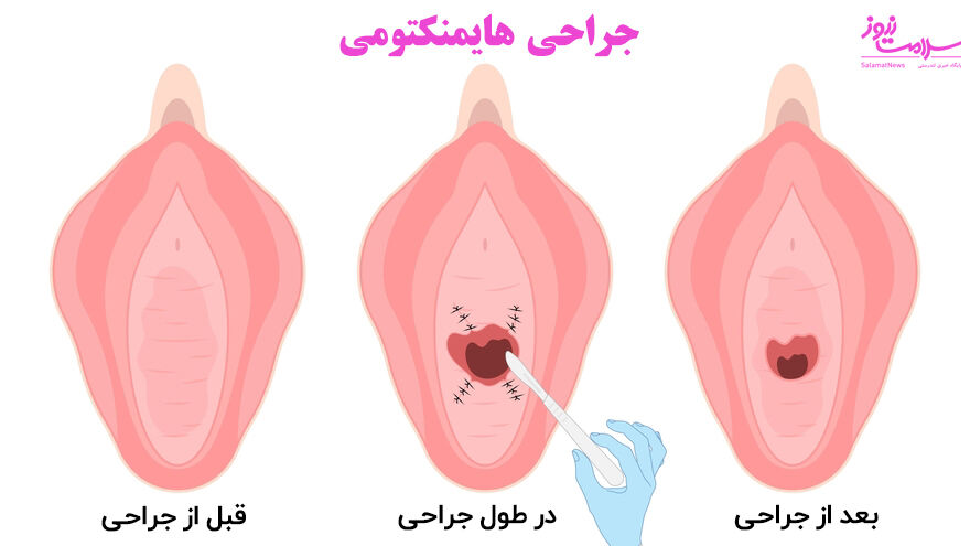 هایمنکتومی بکارت