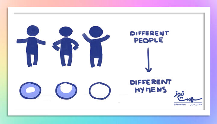 نکاتی درباره پرده بکارت که حتما باید بدانید نکاتی درباره پرده بکارت که حتما باید بدانید