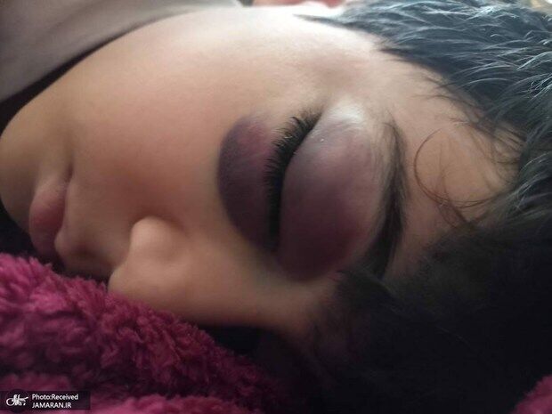 نامه سرگشاده جمعی از خانوادههای کودکان هموفیلی به رییسجمهور:اصرار بر واردات داروی گران برای چه کسانی منفعت دارد؟