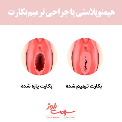 جراحی ترمیم بکارت