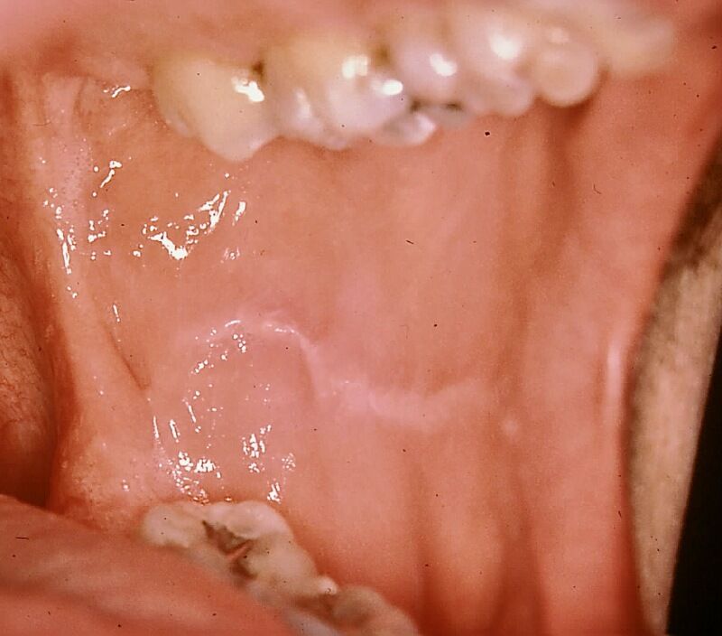 چه چیزی باعث ایجاد خط سفید داخل گونه ها می شود؟ (+عکس)