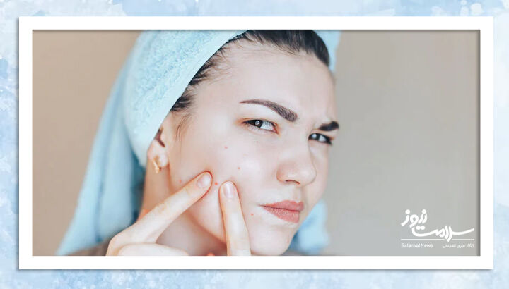 پژوهشی غافلگیر کننده: آکنه برای پوست مفید است پژوهشی غافلگیر کننده: آکنه برای پوست مفید است