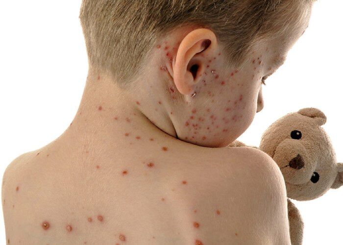 افزایش سرخچه طی ۸ سال گذشته در کشور  افزایش سرخچه طی ۸ سال گذشته در کشور