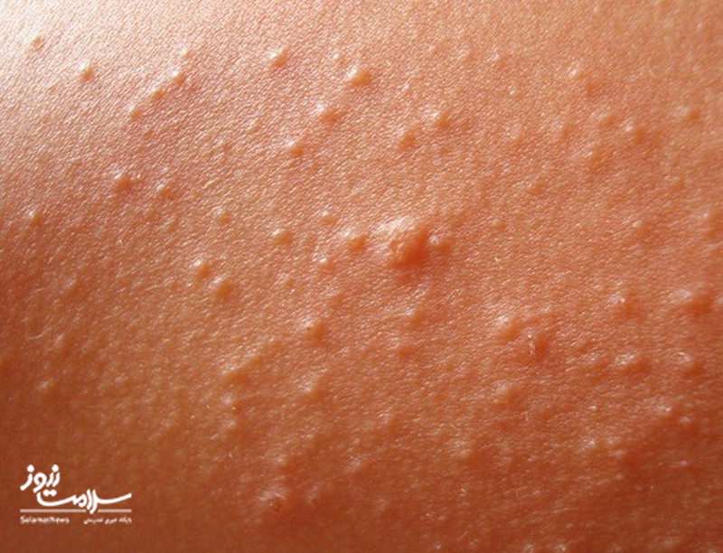 راش گرمایی: دلایل و راههای پیشگیری از آن