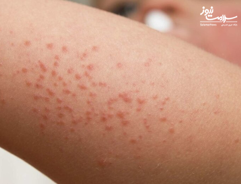 راش گرمایی: دلایل و راههای پیشگیری از آن