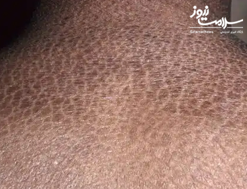 نشانه های بیماری کلیوی که بر روی پوست ظاهر می شوند