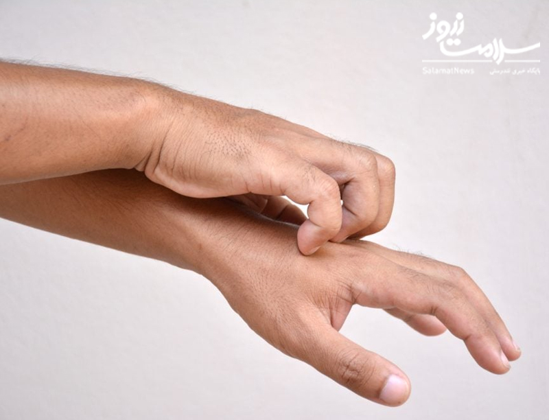 نشانه های بیماری کلیوی که بر روی پوست ظاهر می شوند