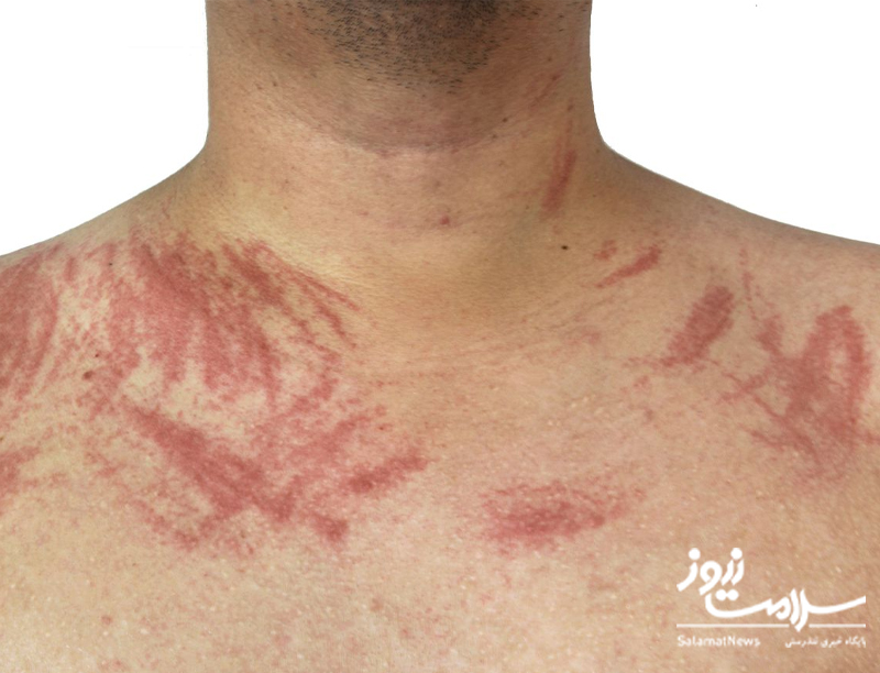 نشانه های بیماری کلیوی که بر روی پوست ظاهر می شوند