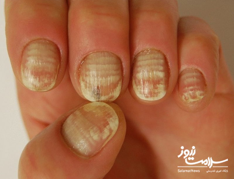 نشانه های بیماری کلیوی که بر روی پوست ظاهر می شوند