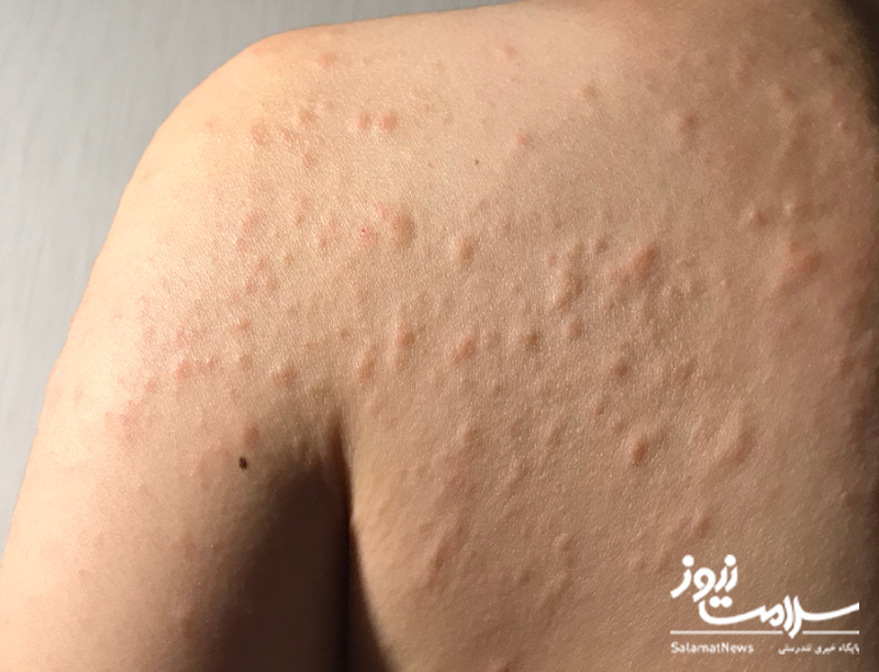 نشانه های بیماری کلیوی که بر روی پوست ظاهر می شوند