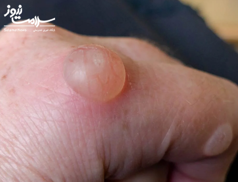 نشانه های بیماری کلیوی که بر روی پوست ظاهر می شوند