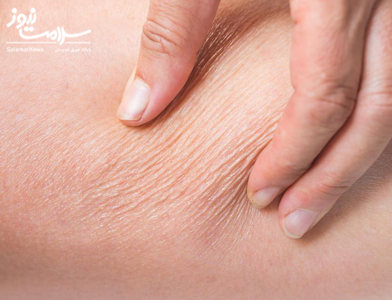 نشانه های بیماری کلیوی که بر روی پوست ظاهر می شوند