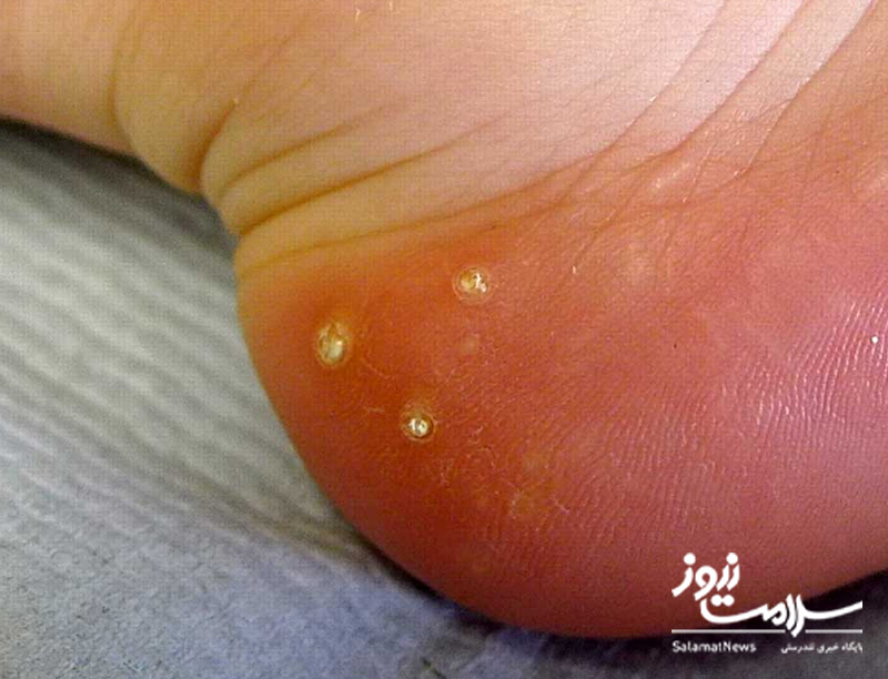 نشانه های بیماری کلیوی که بر روی پوست ظاهر می شوند