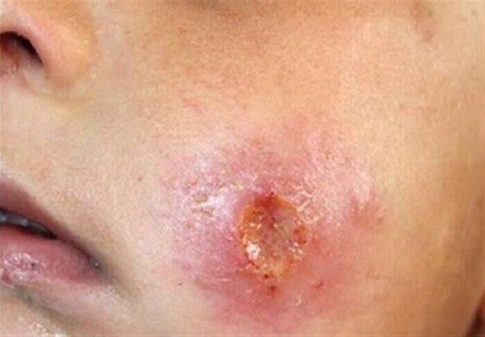 سالک کشنده نیست/ضرورت استفاده از مواد دور کننده حشرات در مناطق روستایی