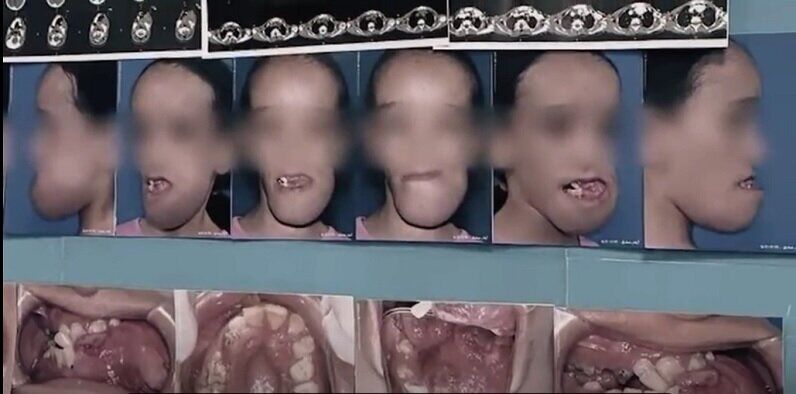 خارج کردن تومور ۷ کیلویی از دهان کودک ۱۱ ساله!/ عکس