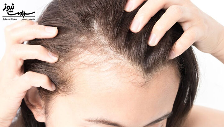 ریزش مو شدید