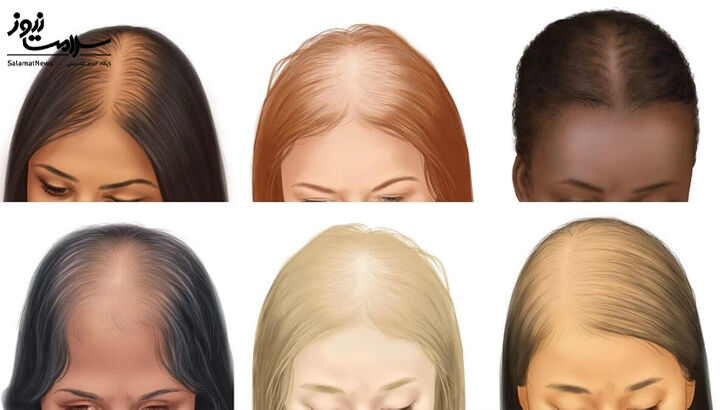 ریزش مو شدید