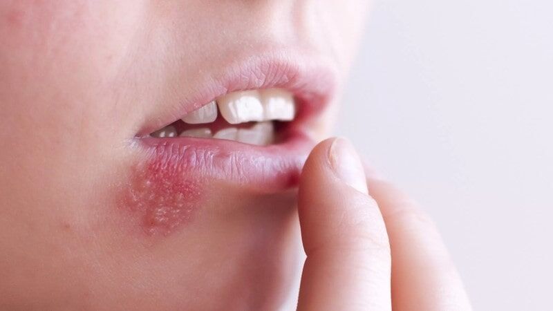 ۷ خوراکی مفید برای کاهش خطر انتقال ویروس تبخال ۷ خوراکی مفید برای کاهش خطر انتقال ویروس تبخال