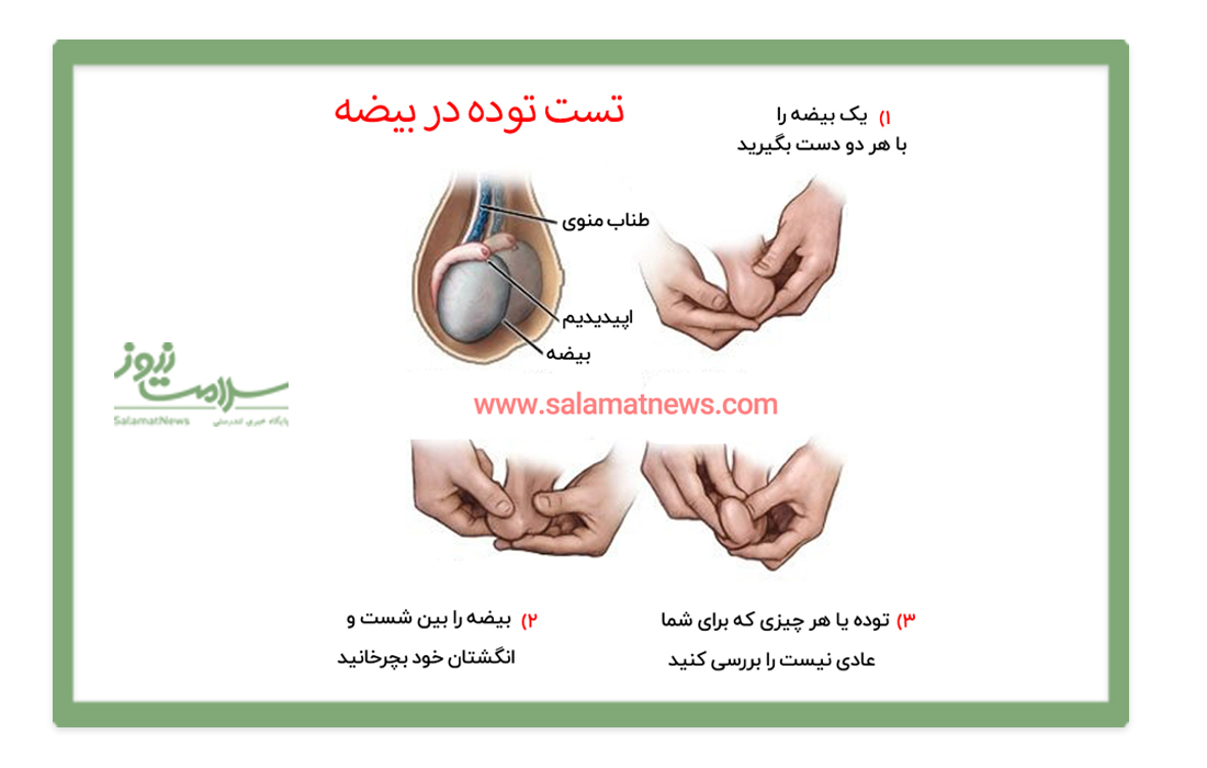 چگونه خودمان وجود توده در بیضه را تشخیص دهیم؟