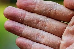 اگزما پوستی چیست و چه علائم و علت هایی دارد ؟