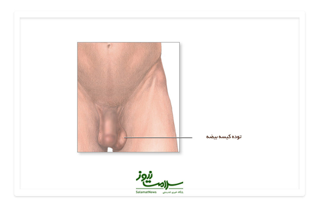 چگونه خودمان وجود توده در بیضه را تشخیص دهیم؟