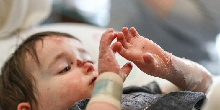 تحریم پانسمان بیماران پروانهای از سوی سوئد؛ دردی ماندگار برای مبتلایان به «ایبی» تحریم پانسمان بیماران پروانهای از سوی سوئد؛ دردی ماندگار برای مبتلایان به «ایبی»