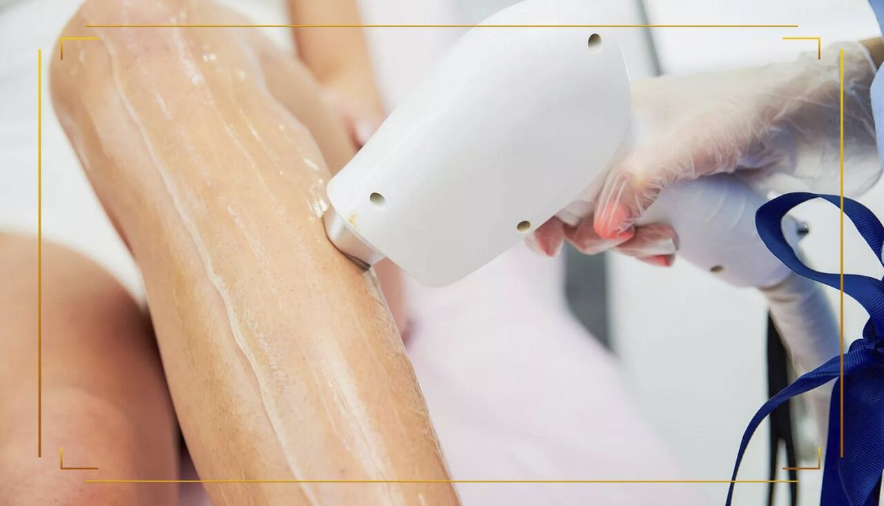 لیزر موهای زائد | فواید، عوارض، هزینه و تعداد جلسات لیزر موهای زائد | فواید، عوارض، هزینه و تعداد جلسات