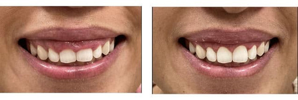 کاربردهای لیزر ، لیفت لثه دکتر علیرضا میرزایی