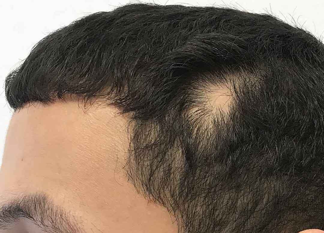 درباره آلوپِسی آرِئاتا یا کچلی سکه ای (+عکس) درباره آلوپِسی آرِئاتا یا کچلی سکه ای (+عکس)