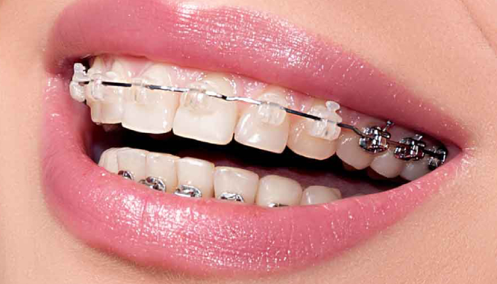 دندان قروچه و ارتودنسی