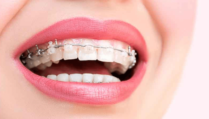 ارتودنسی دندان برای اصلاح طرح لبخند