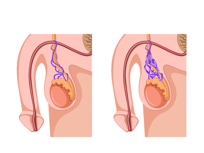آیا درمان واریکوسل با یخ، قارچ گانودرما و موارد این چنینی امکان پذیر است؟