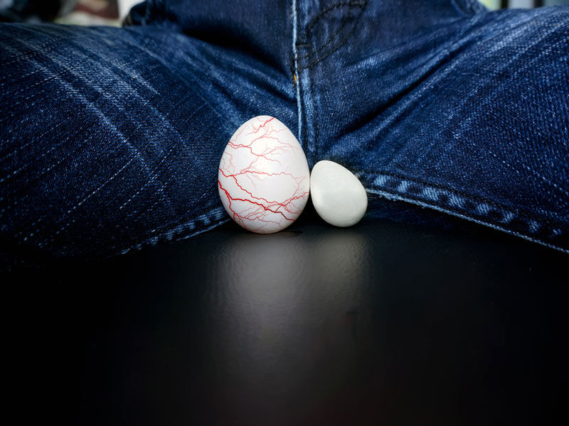 آیا درمان واریکوسل با یخ، قارچ گانودرما و موارد این چنینی امکان پذیر است؟ آیا درمان واریکوسل با یخ، قارچ گانودرما و موارد این چنینی امکان پذیر است؟