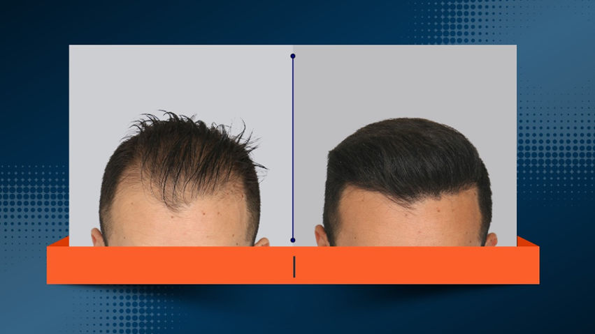 کاشت مو در بیماران دیابتی چگونه است؟