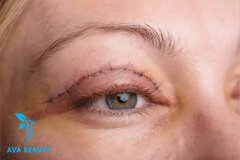 علت کوچک شدن چشم بعد از عمل بلفاروپلاستی چیست؟ + درمان