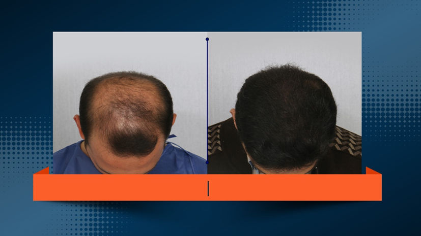 کاشت مو در بیماران دیابتی چگونه است؟ کاشت مو در بیماران دیابتی چگونه است؟