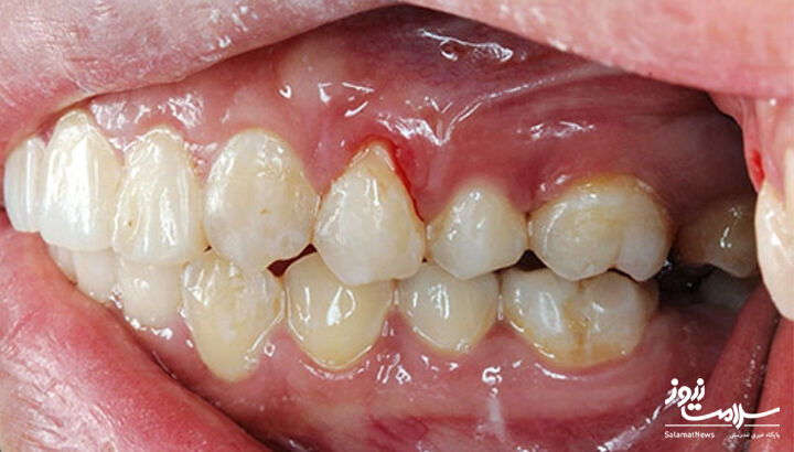 خونریزی لثه