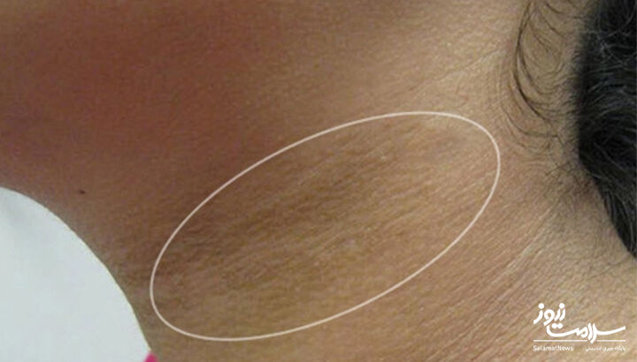 لکه های تیره پوستی