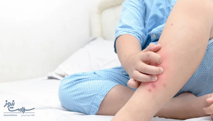 خارش بدن کودک