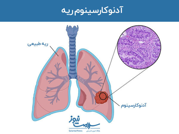 آدنوکارسینوم