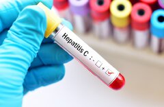 درمان هپاتیتC اجباری شود