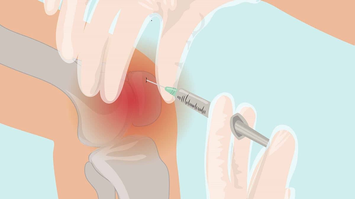 درمان و بهبود آرتروز مفصل زانو با روش PRP درمان و بهبود آرتروز مفصل زانو با روش PRP