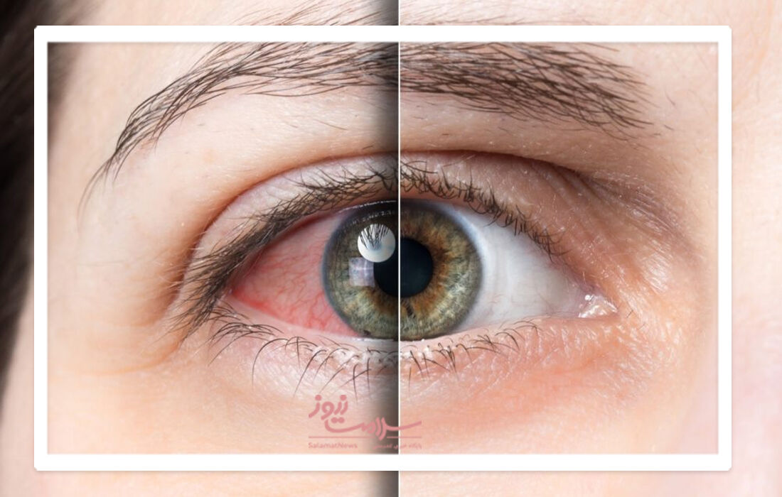 آرتریت روماتوئید چگونه بر چشم‌ها اثر می‌گذارد؟