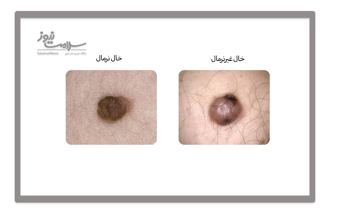 نحوه تشخیص بی خطر بودن خال ها